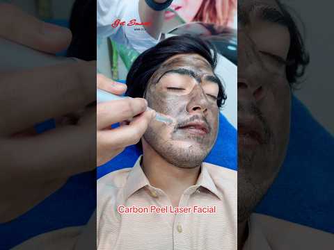 Carbon Peel Laser Facial #getsmarthairclub #viralvideo #viralshort