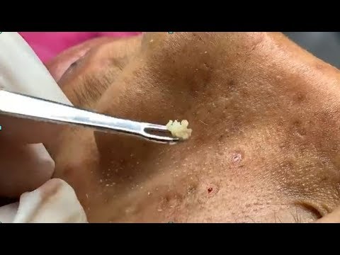 How To Rid Of Pimples, Acnes Removal, Pimple Popper Videos 2019