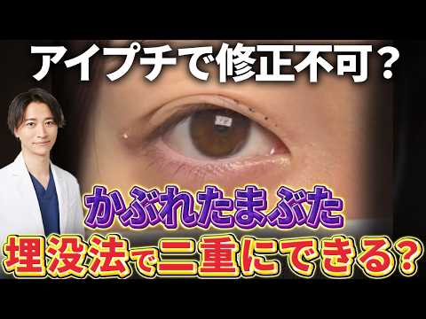 他院修正不可？アイプチかぶれの瞼を二重埋没で治す方法！【二重整形/埋没法】