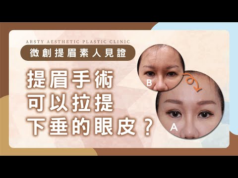 【微創提眉術後一週素人見證】提眉手術可以拉提下垂的眼皮？| 璞美整形外科醫美診所