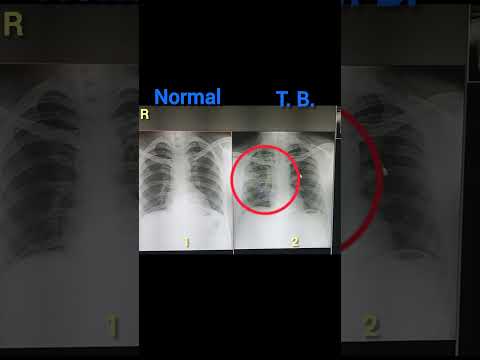 Normal 🆚T. B. X ray #medicalimaging