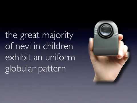 Nevus pattern in childhood by Dr. Iris Zalaudek