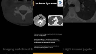 Lemierre's syndrome#Jugular Septic thrombophlebitis with lung nodules.