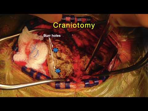 Microsurg resect of a GBM of the medulla oblongata with intraop subcortical stimulation and mapping