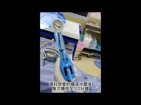 耳咽管氣球擴張術 balloon tuboplasty for Eustachian tube dysfunction