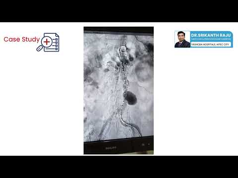 #Case Study-Aortic Aneurysm | Dr.Srikanth Raju | Vascular and Endovascular Surgeon | Hyderabad