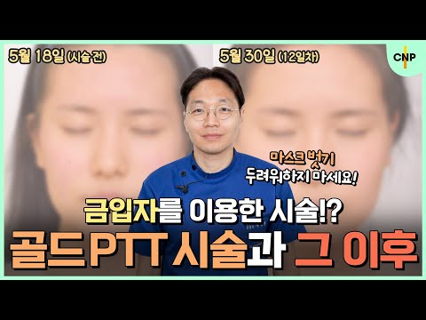 "골드 PTT"로 여드름 맘고생 끝! 시술 과정까지 싹- 보여드립니다! [여드름, 주사피부염 치료]