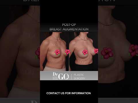 Before and After Breast Augmentation #breastaugmentationsurgery #drgo