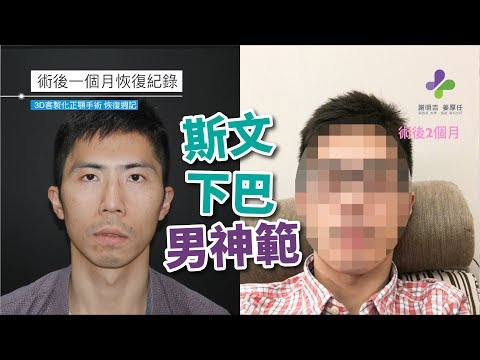 姜厚任醫師｜3D客製化正顎手術｜改善下顎後縮臉型、睡眠呼吸中止｜1個月恢復紀錄