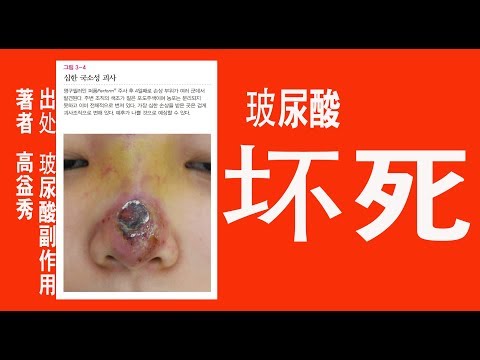 玻尿酸壞死治療方法