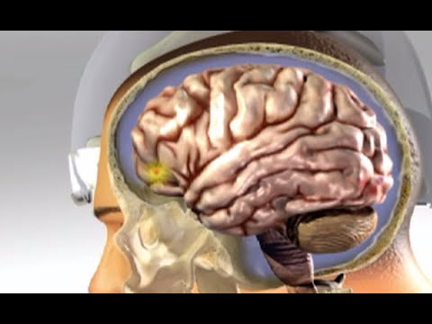 Concussion Recognition And Recovery - Part 1