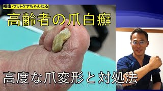 高齢者の爪白癬　高度な爪変形と対処法