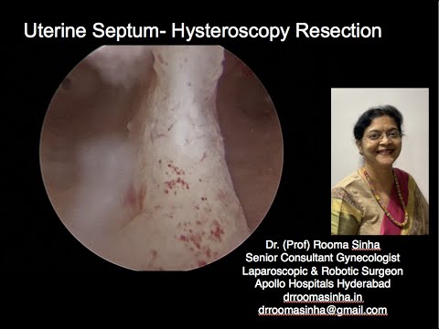 Hysteroscopy Septal Resection  Dr Rooma Sinha Apollo Hospitals, Hyderabad