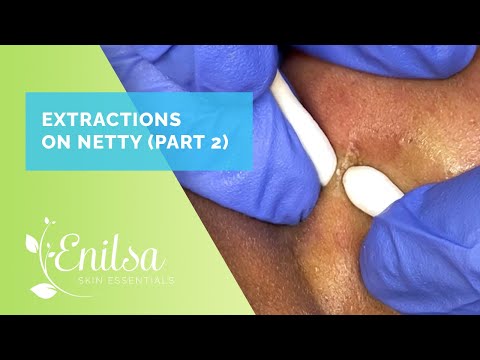 Blackhead Extractions on Netty - Second Treatment