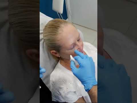 Revitalize Your Eyes: Tear Troughs Treatment at Plantation Med Spa, Florida #shorts