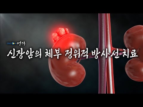 [명의 의학백과📖] 신장암의 체부 정위적 방사선 치료