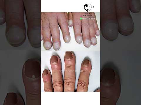 உங்கள் நகங்கள் இவ்வாறு இருக்கிறதா? Changes in nails and diseases- Dr. Isacc Abbas