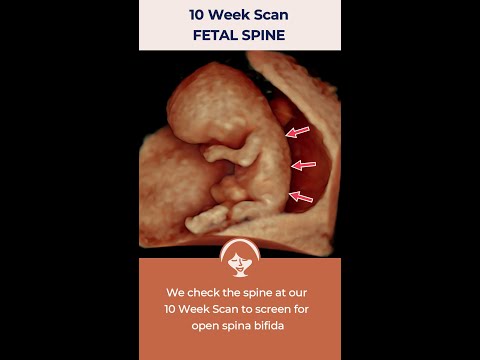 10 Week Scan for Baby's Spine #EarlyDetection #PrenatalCare