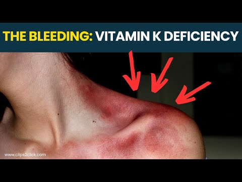 Vitamin K Deficiency Symptoms: Scary Signs You're Bleeding Too Much