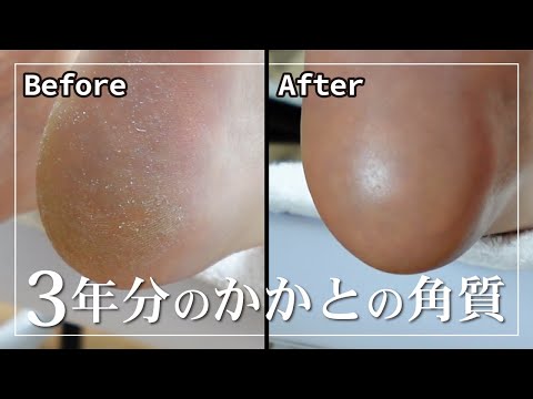 【一生取れる角質】フットケアでつるつるになりました！(後編)[角質除去][フットマッサージ][ネイルケア]