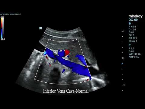 Duplex Scanning of Inferior Vena Cava (IVC), Aorta and Superior Mesenteric Artery (SMA)