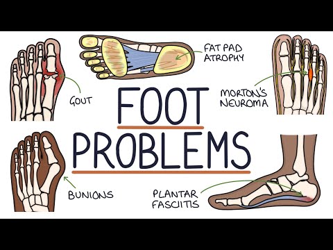 Common Foot Problems