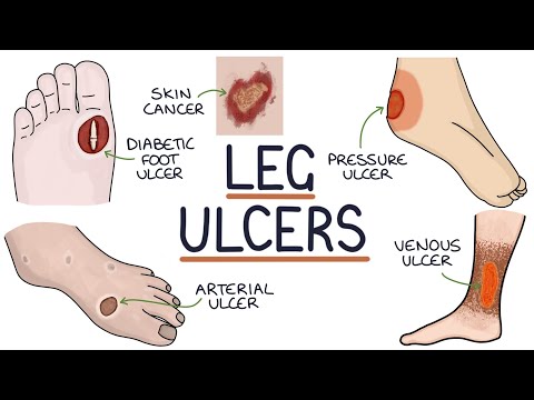 Understanding Leg and Foot Ulcers