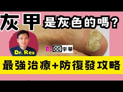 灰甲是灰色的嗎？最好的治療和預防復發指南。Tinea unguium the treatment