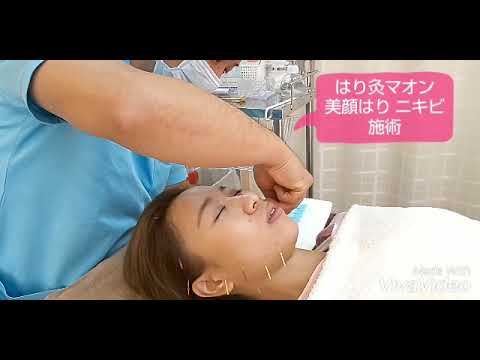 はり灸マオン　美顔鍼　「ニキビ施術」