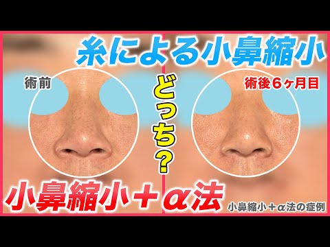 【鼻整形】切らずに糸による小鼻縮小と切る小鼻縮小(小鼻縮小＋α法)を比較解説