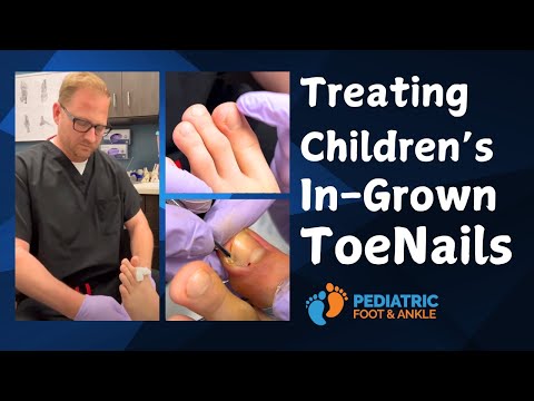 Treating Children's Ingrown Toenails with Dr. Jarman (Graphic Content)