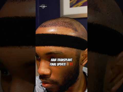 Hair Transplant Final Update👨🏾‍🦲‼️