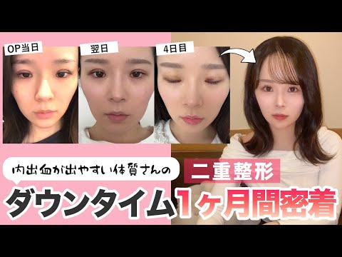 【ダウンタイム密着】新卒スタッフちゃんの二重整形密着後編！埋没二重整形の1ヶ月間の経過をまとめてみた