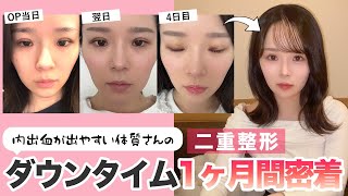 【ダウンタイム密着】新卒スタッフちゃんの二重整形密着後編！埋没二重整形の1ヶ月間の経過をまとめてみた