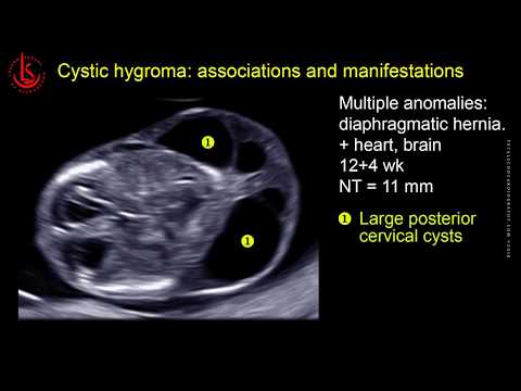 Cystic hydroma and nuchal edema at 11-13 weeks of pregnancy