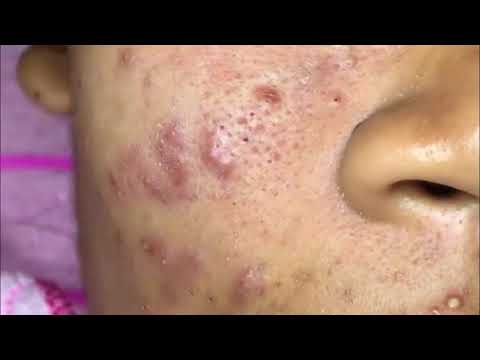 Acne Treatment 2019 | Milia