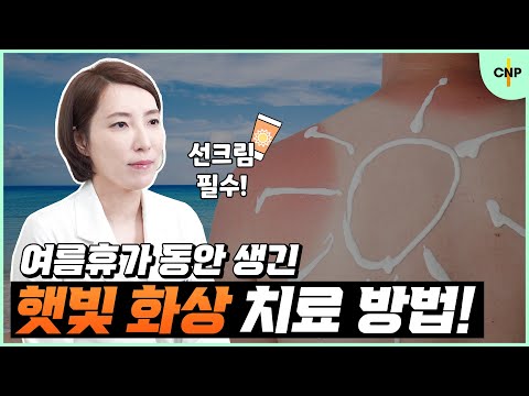 여름철 휴가, 바캉스에서 생긴 햇빛 화상 치료 방법! [일광 화상 치료법]