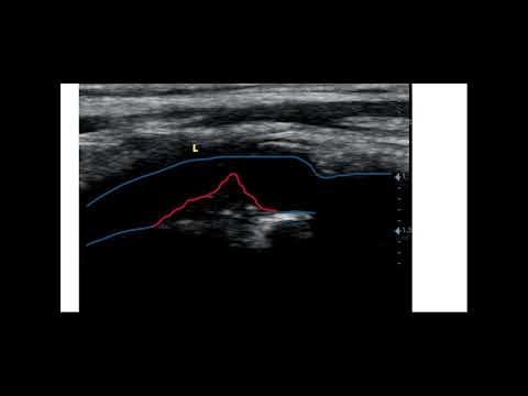 High grade carotid stenosis and amaurosis fugax Duplex images and videos