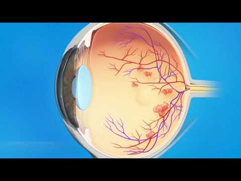 Vitrectomie pour hémorragie du vitré - Opération de l'hémorragie intravitréenne