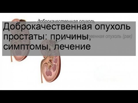 Доброкачественная опухоль простаты: причины, симптомы, лечение