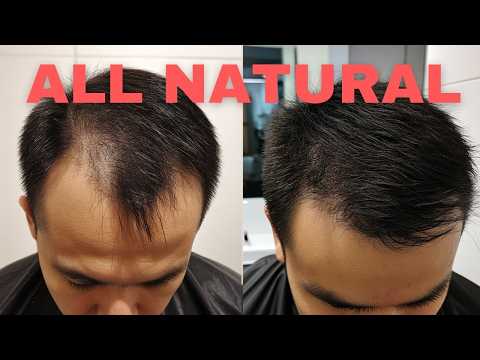 How To Stop Hair Loss Naturally - Top 3 Options