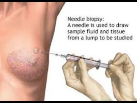 Understanding Fine Needle Aspiration #ultrasound #sonographer #health #ultrasoundtech #science