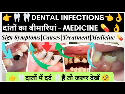 दांत संक्रमण  | Dental Infection | Dental pain | Medicine knowledge | Doctor | Dentist | Nursing