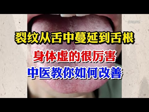 裂纹从舌中裂到舌根处，身体虚得不行，该怎么办呢？