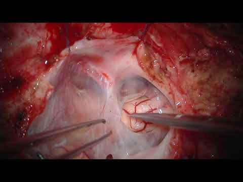 Cisterna magna reconstruction with arachnoid suturing in brainstem surgery