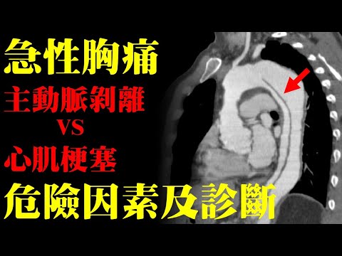 急性胸痛，是主動脈剝離還是心肌梗塞？診斷及危險因素？｜許原彰醫師