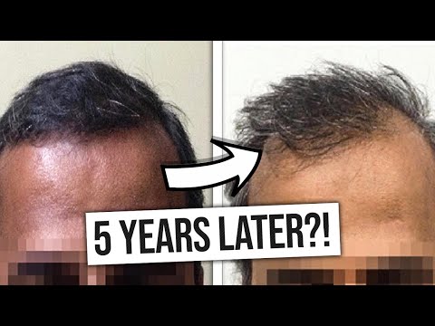 Hair Transplants: Do They Last Forever? - The Truth