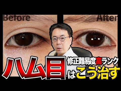 【ハム目】二重切開法でハム目に！修正の名医が症例写真つきで治し方を解説！