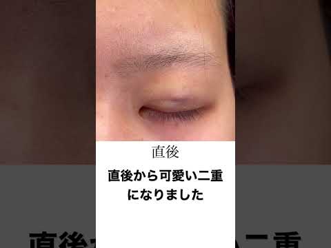 【激変二重】重たい目元もこの通り！【美の主治医京様】