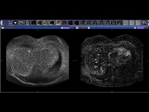 Renal Mass MRI